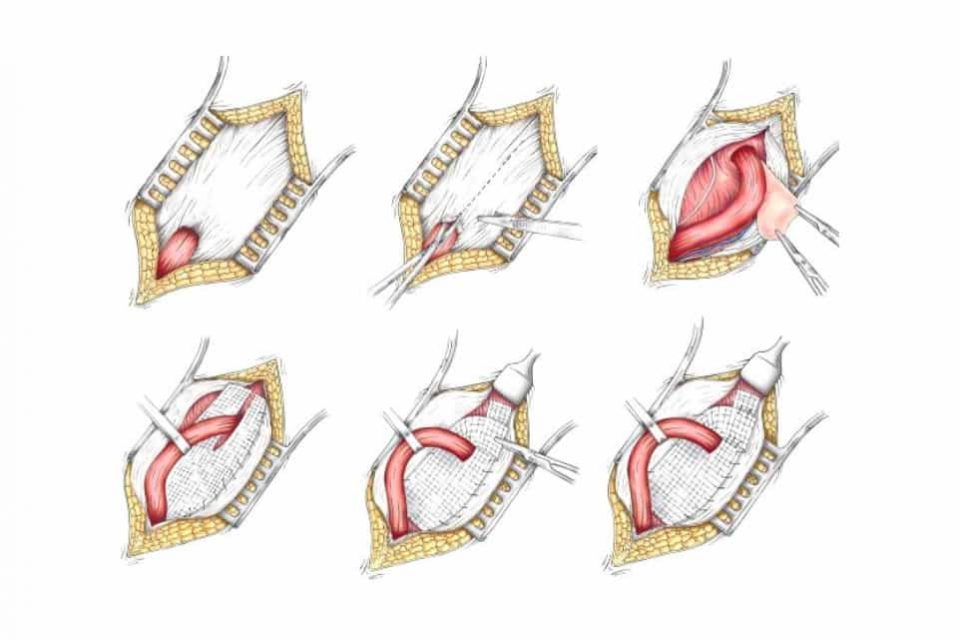 Plug mesh repair of left femoral hernia