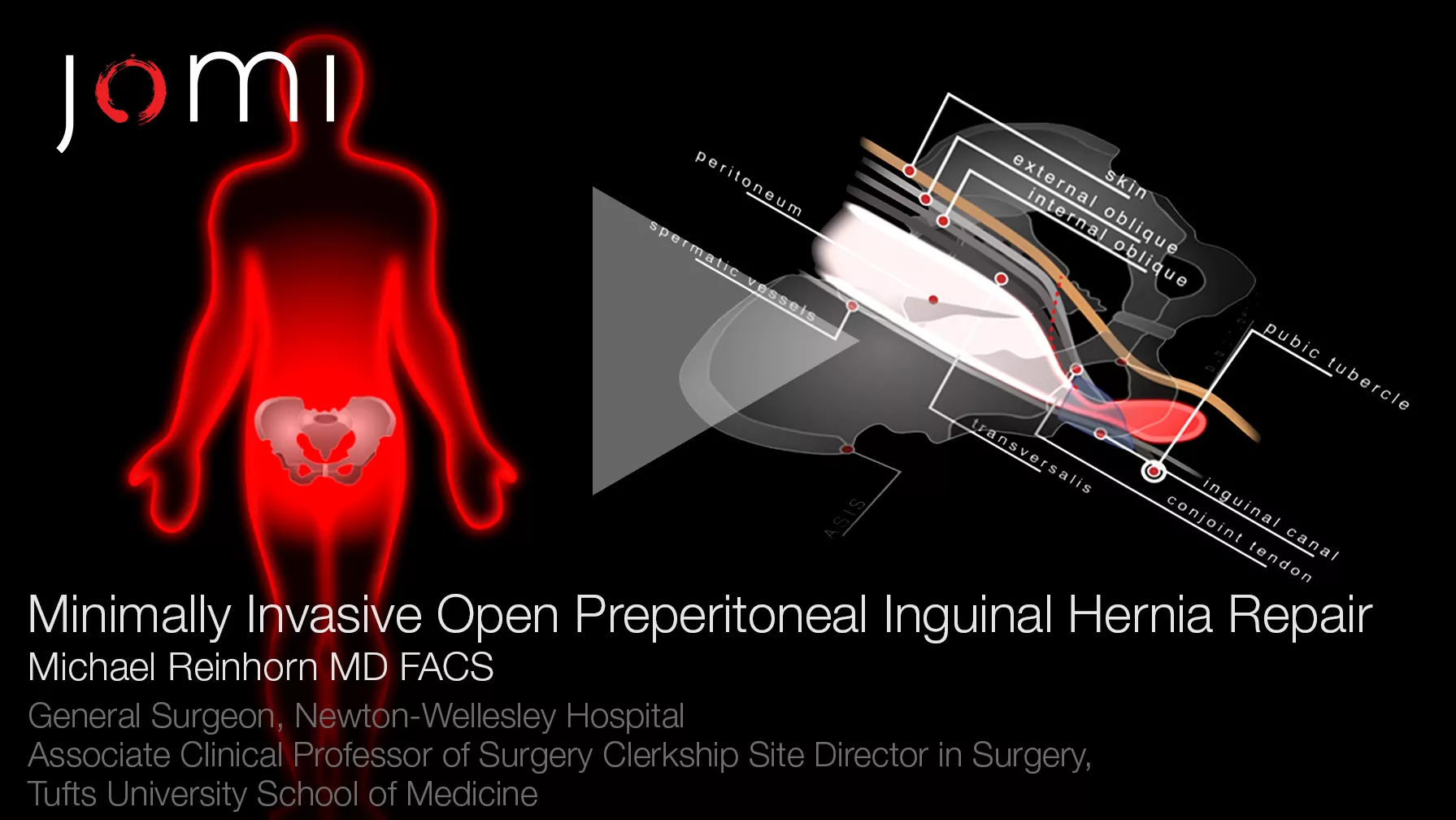 Hernia Repair