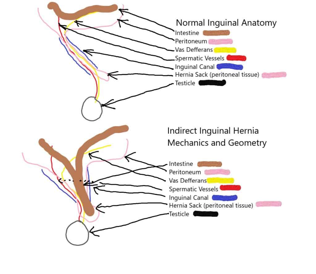 Indirect Inguinal hernia Mechanics and Geometry - Boston Hernia